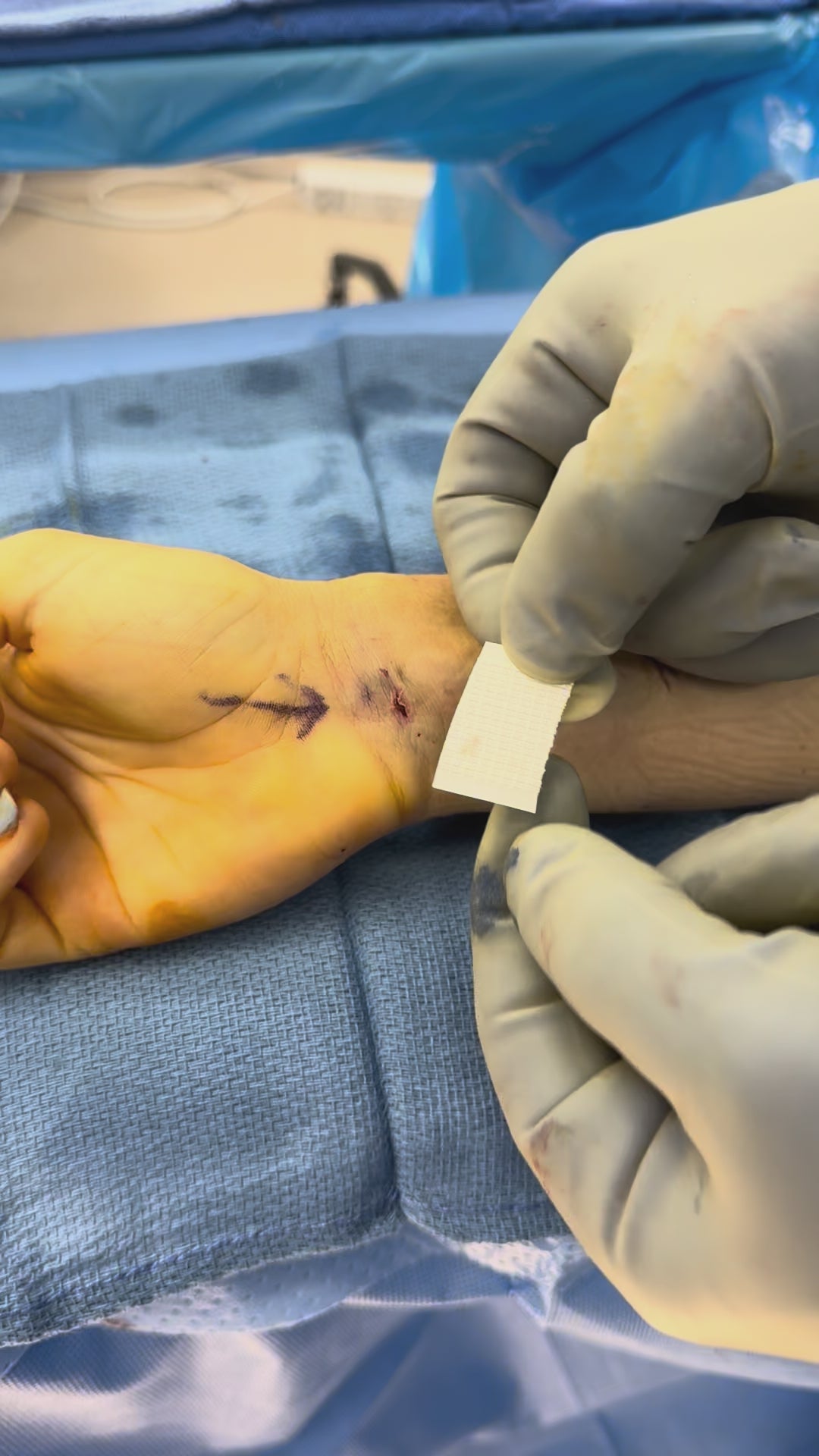 Load video: SYLKE application, Tommy John graft harvest wrist incision