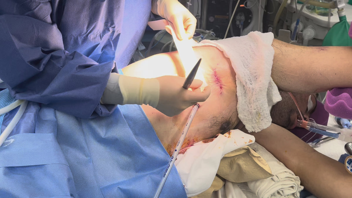 Load video: SYLKE application, VATS incision