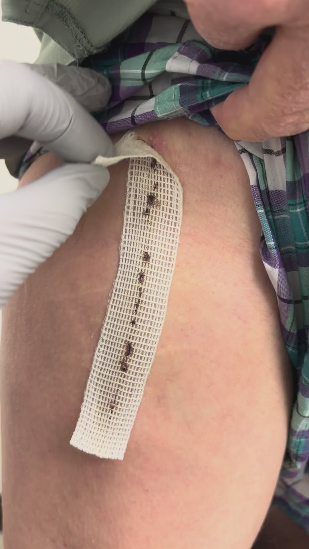 Load video: THA Removal – Robert Benjamin Jones, MD