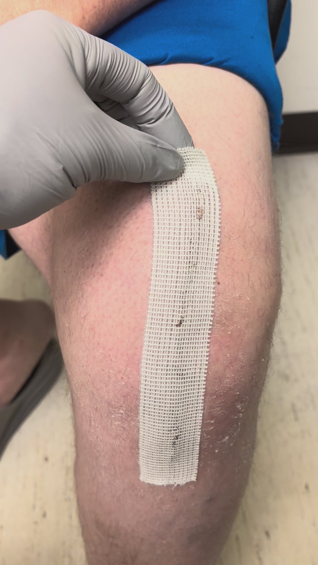 Load video: TKA Removal – Robert Benjamin Jones, MD