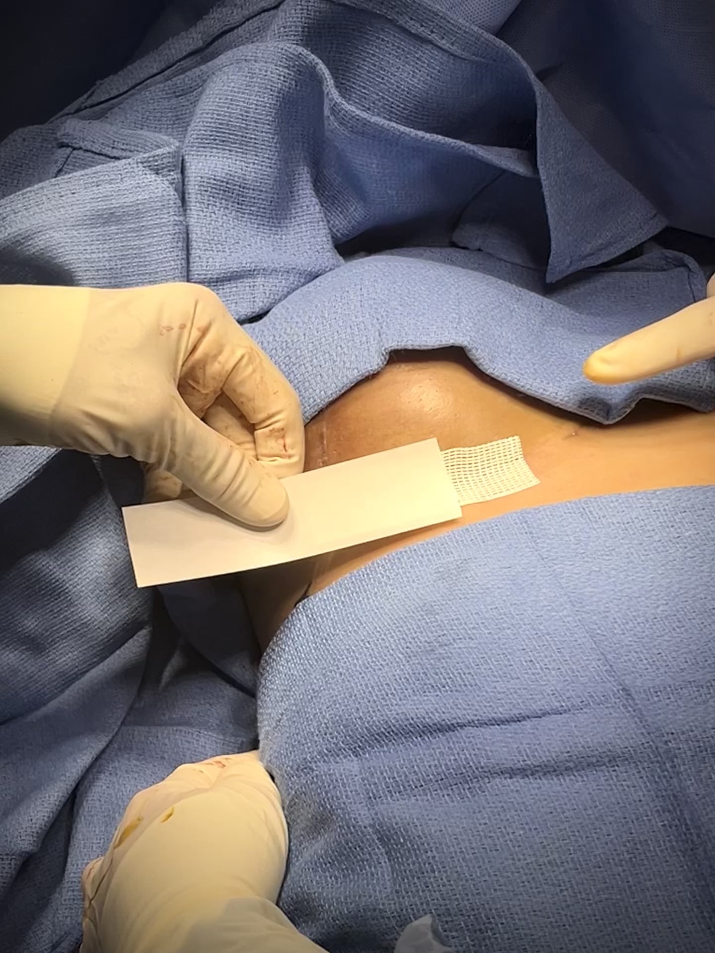 Abdominoplasty — SYLKE