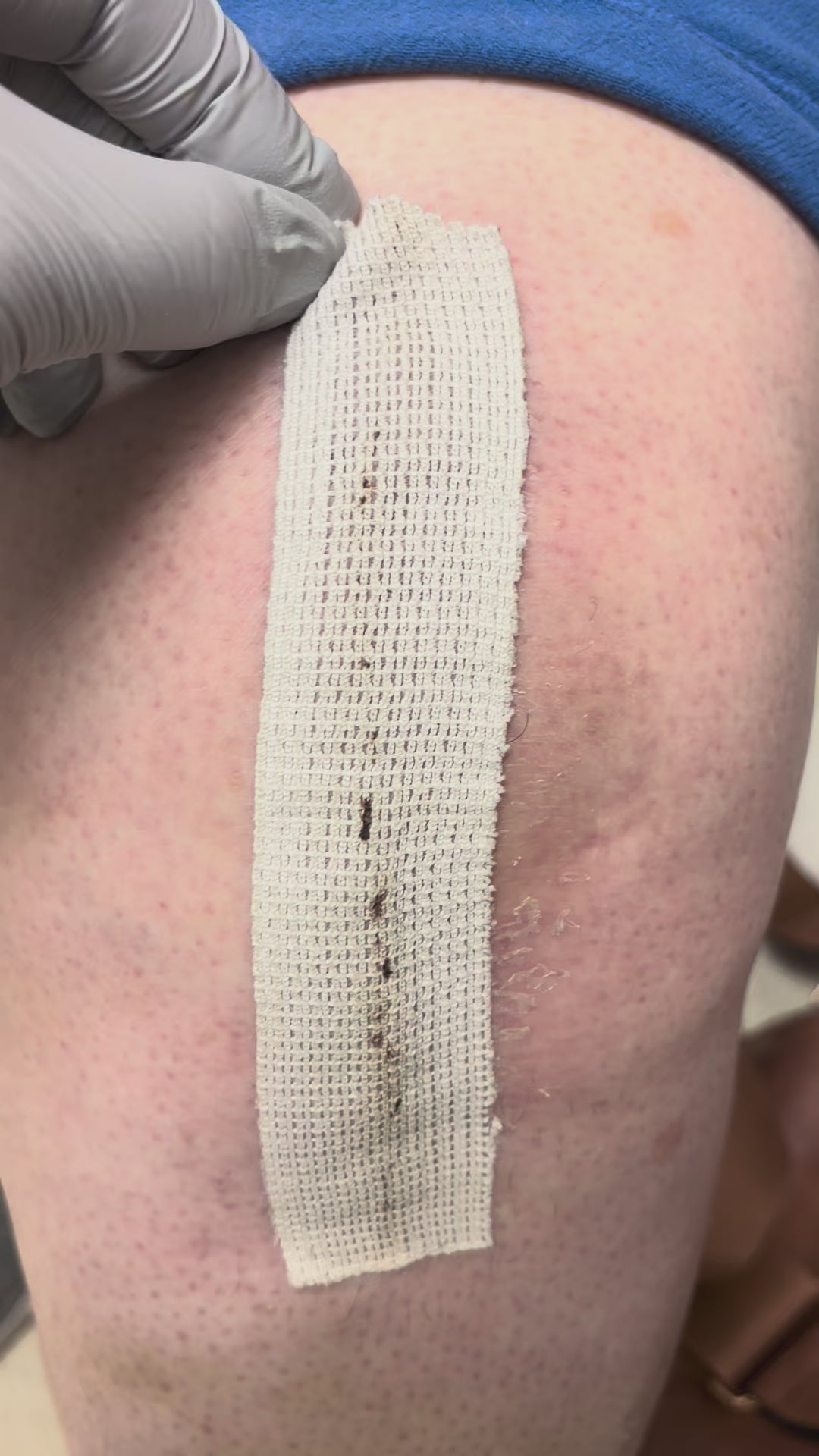 Load video: TKA Removal – Robert Benjamin Jones, MD