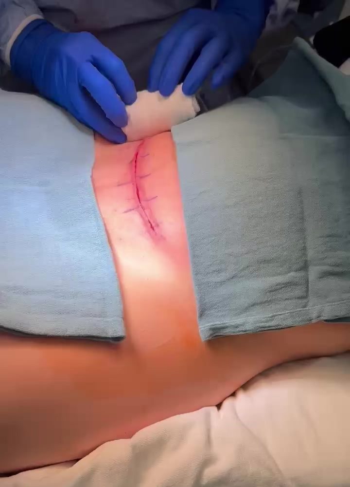 Mastopexy — SYLKE