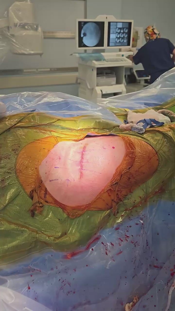 Total Hip Arthroplasty — SYLKE Application