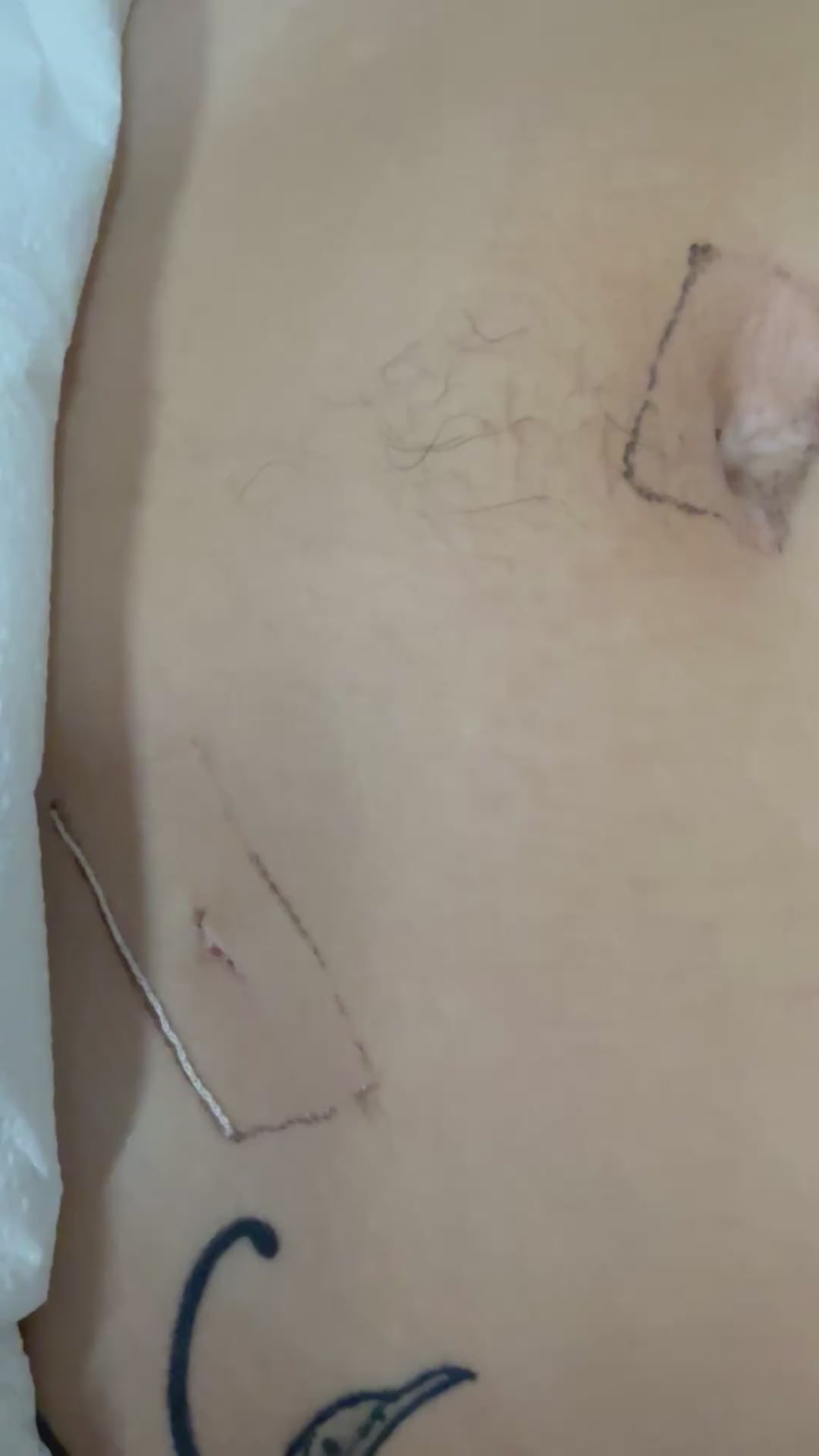 Load video: After SYLKE removal, laparoscopic hysterectomy port sites