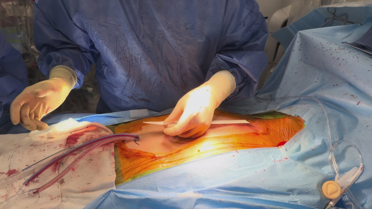 Load video: SYLKE application, off-pump CABG sternotomy incision