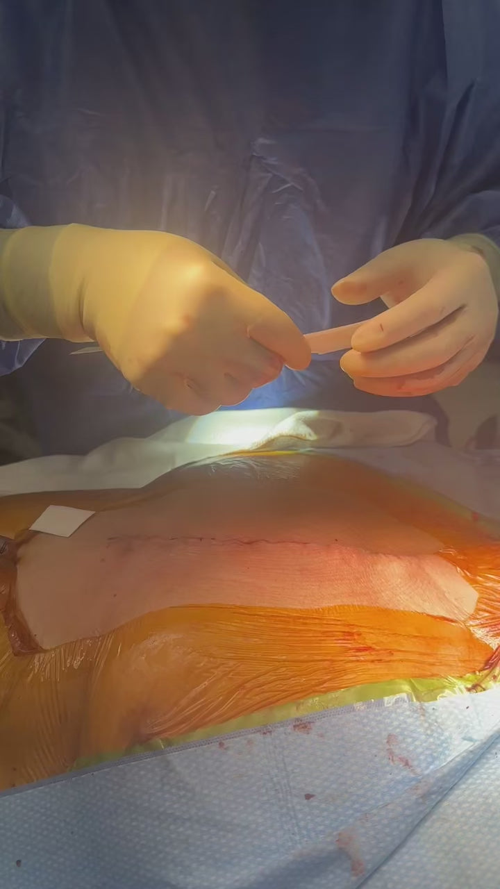 Load video: SYLKE application, off-pump CABG sternotomy incision