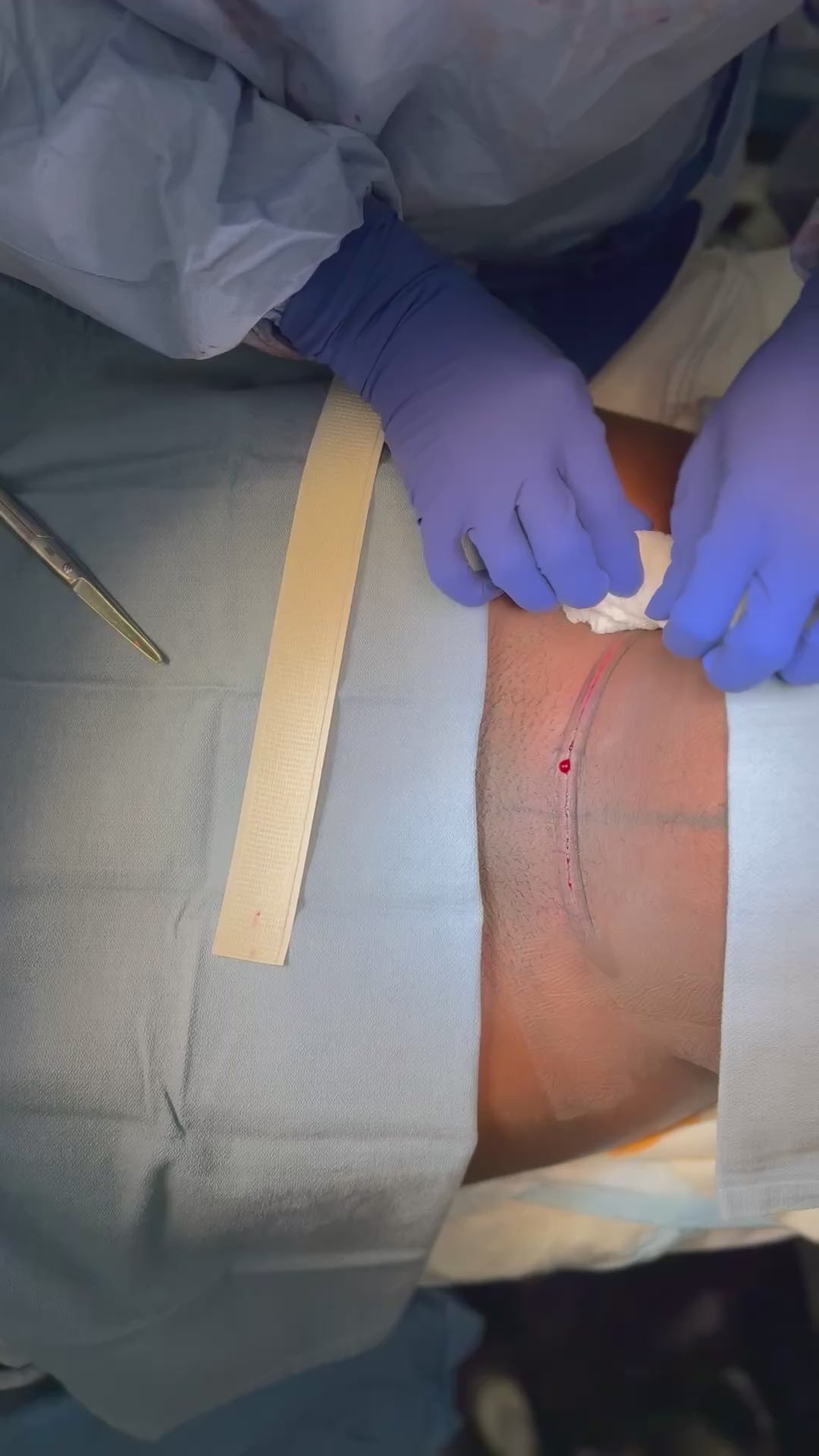 Load video: SYLKE application, cesarean section incision