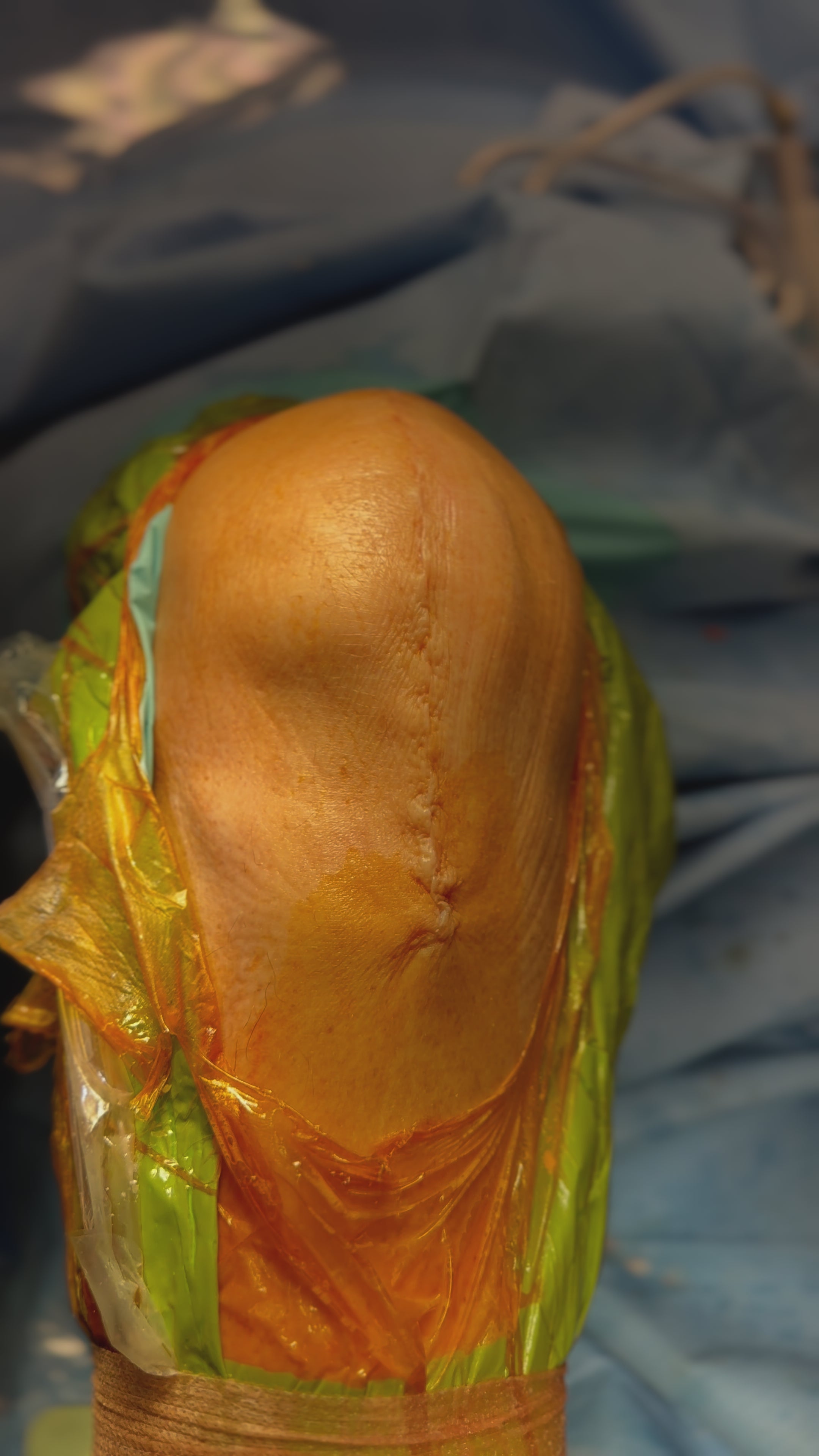 Total Knee Arthroplasty — SYLKE Application