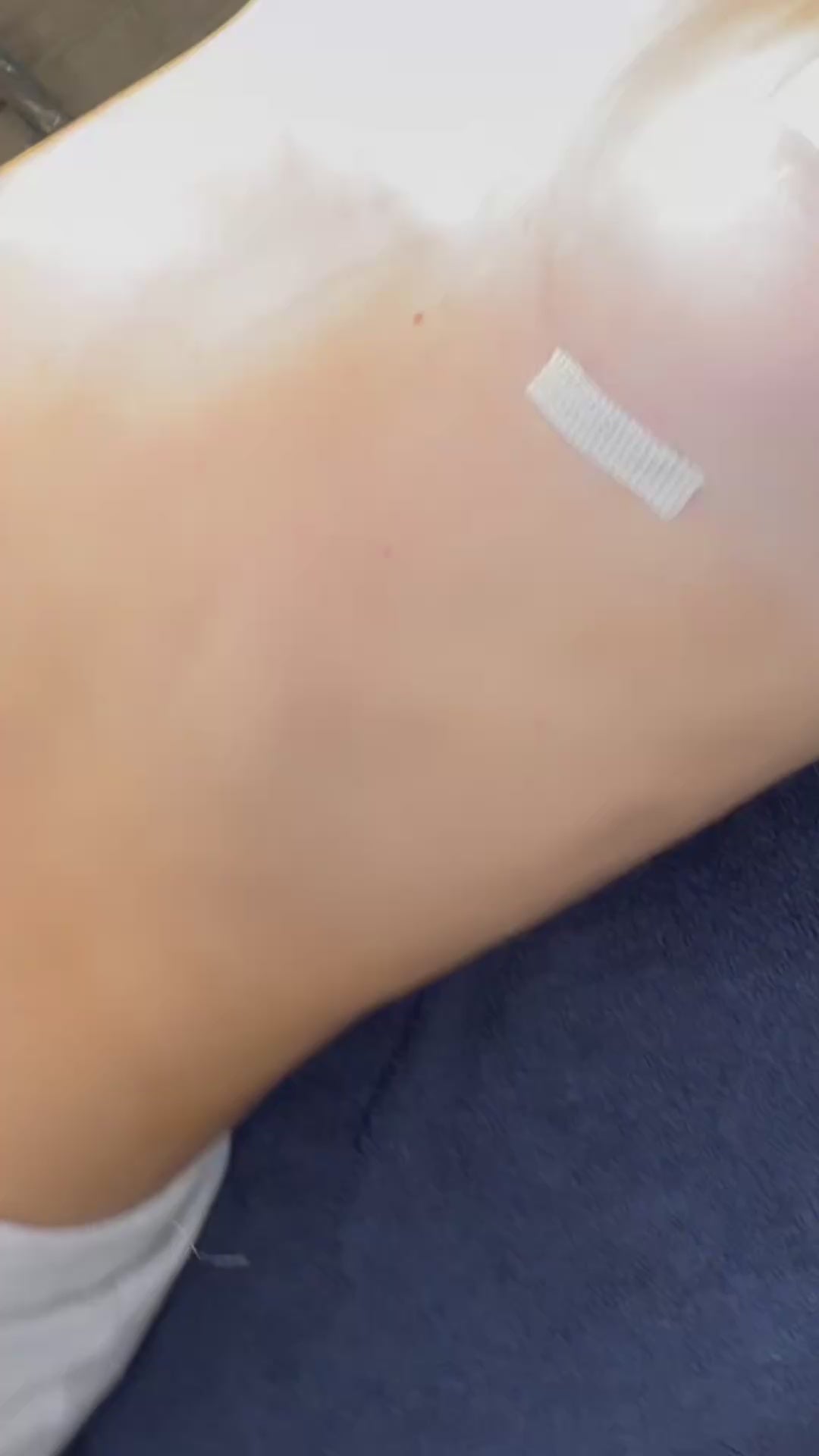 Load video: SYLKE application, breast augmentation incisions