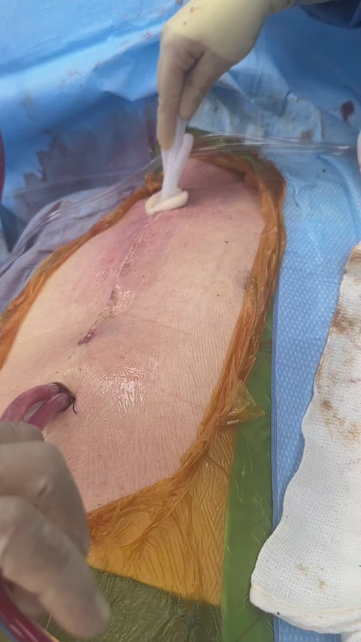 Load video: CABG Application – Li Poa, MD, FACS