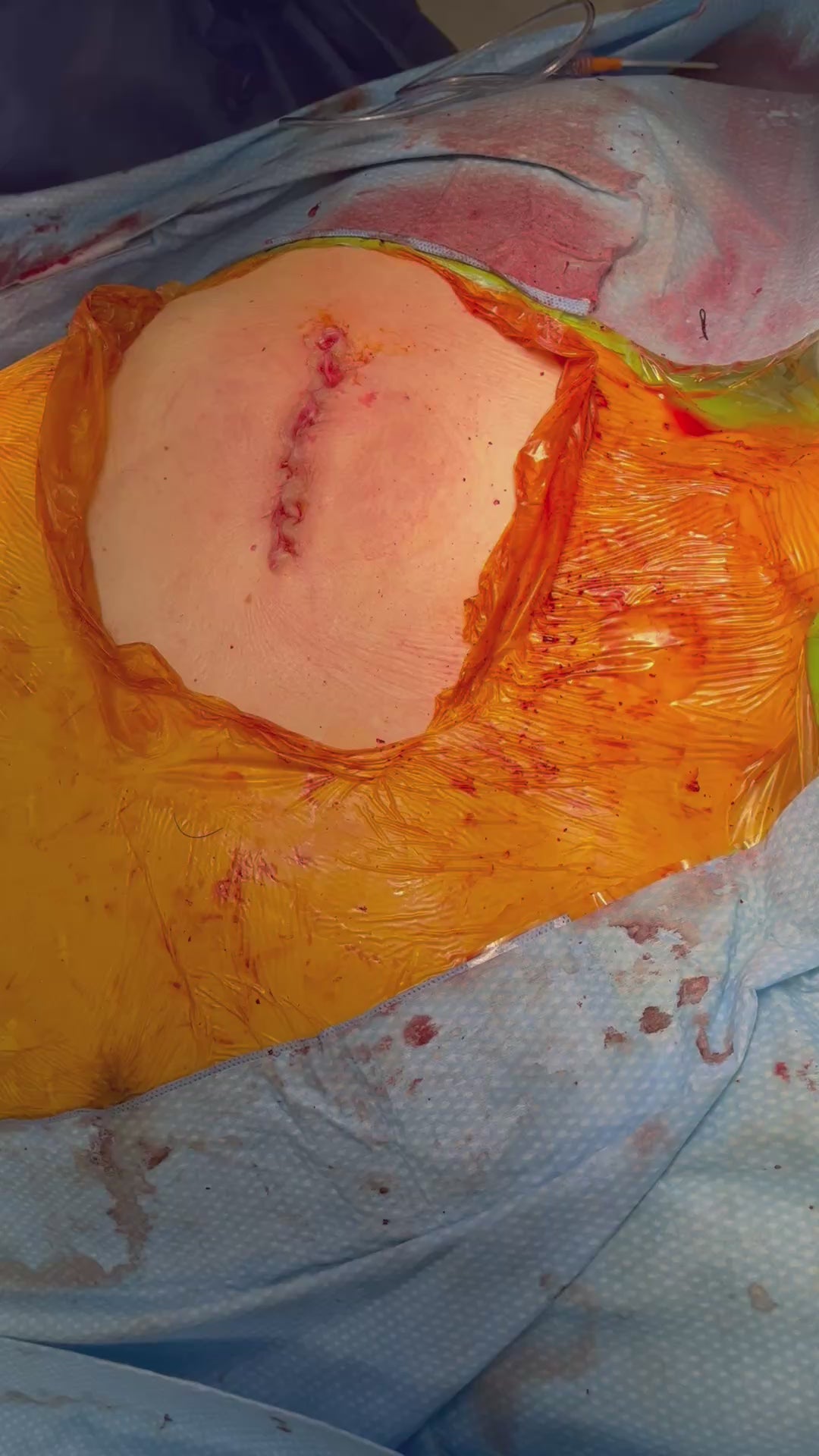 Load video: SYLKE application, mini-access aortic valve replacement incision