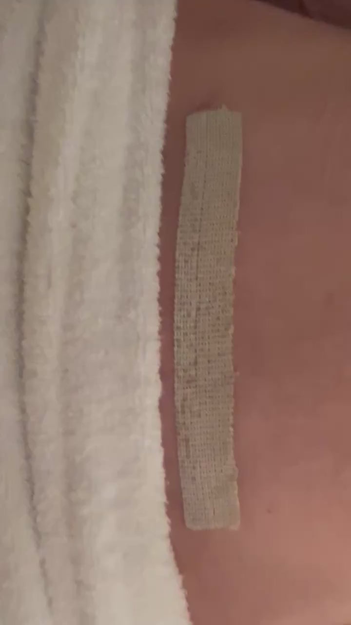 Load video: Cesarean section SYLKE removal