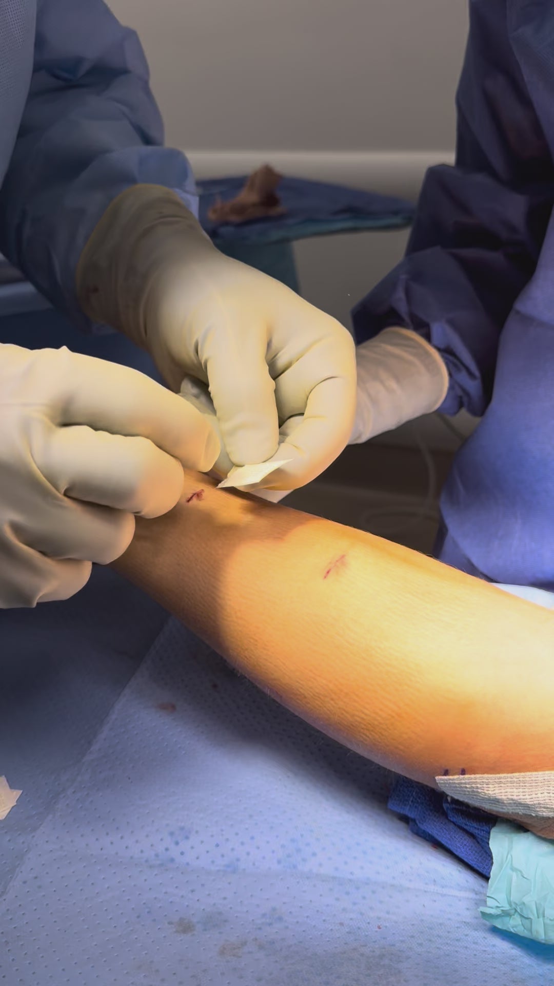 Load video: Tommy John Application – Raffy Mirzayan, MD