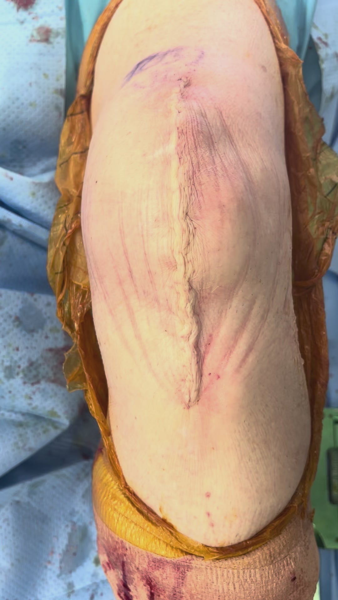 Load video: TKA Application – Robert Benjamin Jones, MD