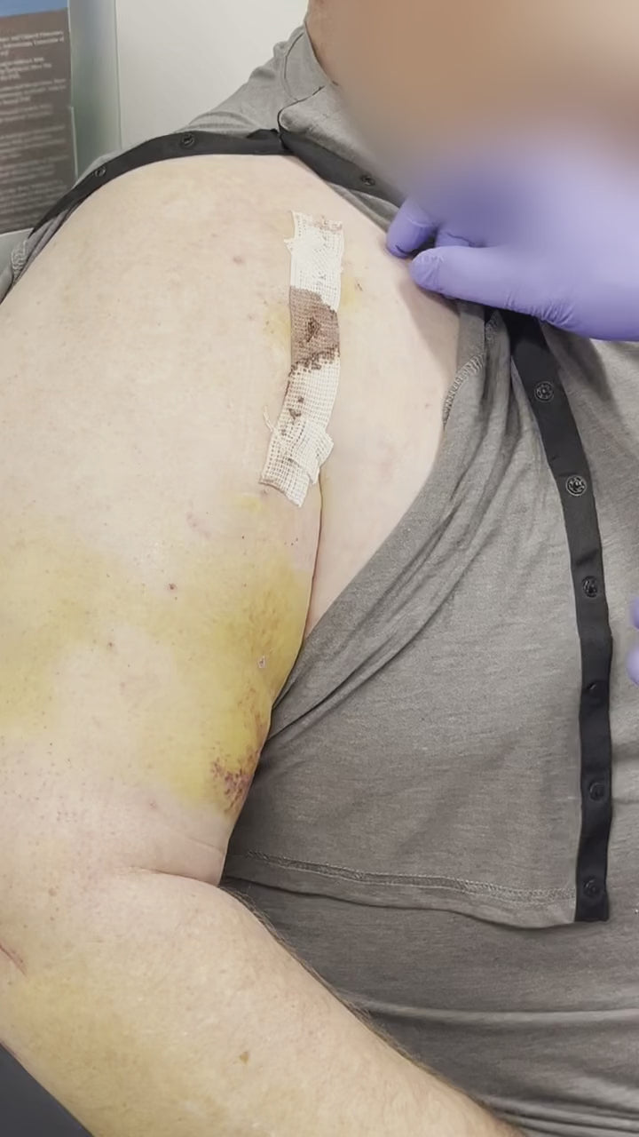 Load video: Shoulder arthroplasty SYLKE removal