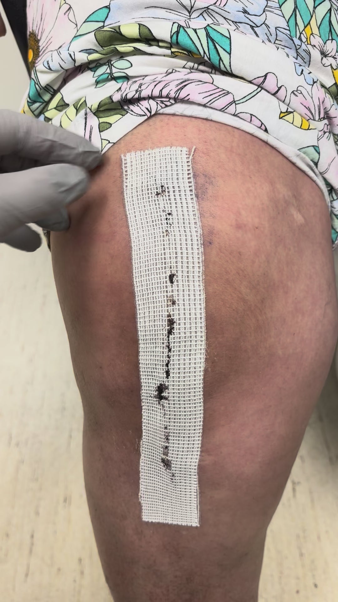 Load video: TKA Removal – Robert Benjamin Jones, MD