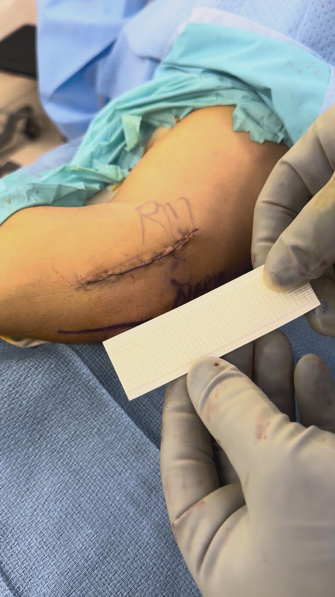 Load video: SYLKE application, Tommy John elbow incision