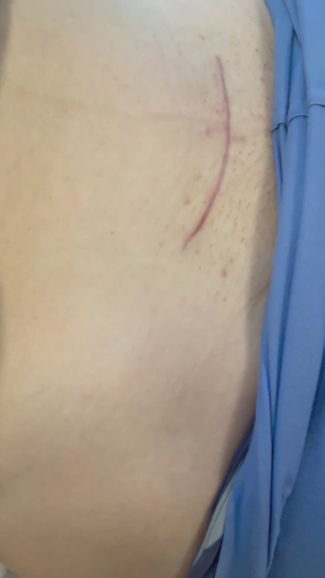 Load video: Cesarean section incision at follow-up after SYLKE
