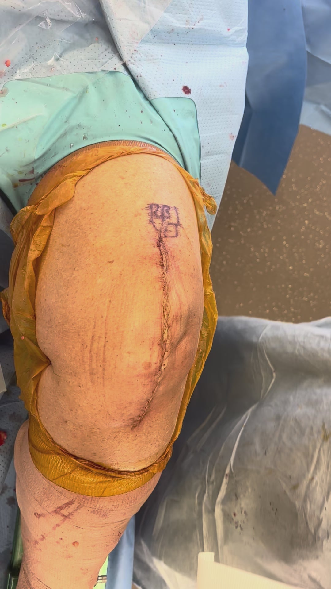 Load video: TKA Application – Robert Benjamin Jones, MD