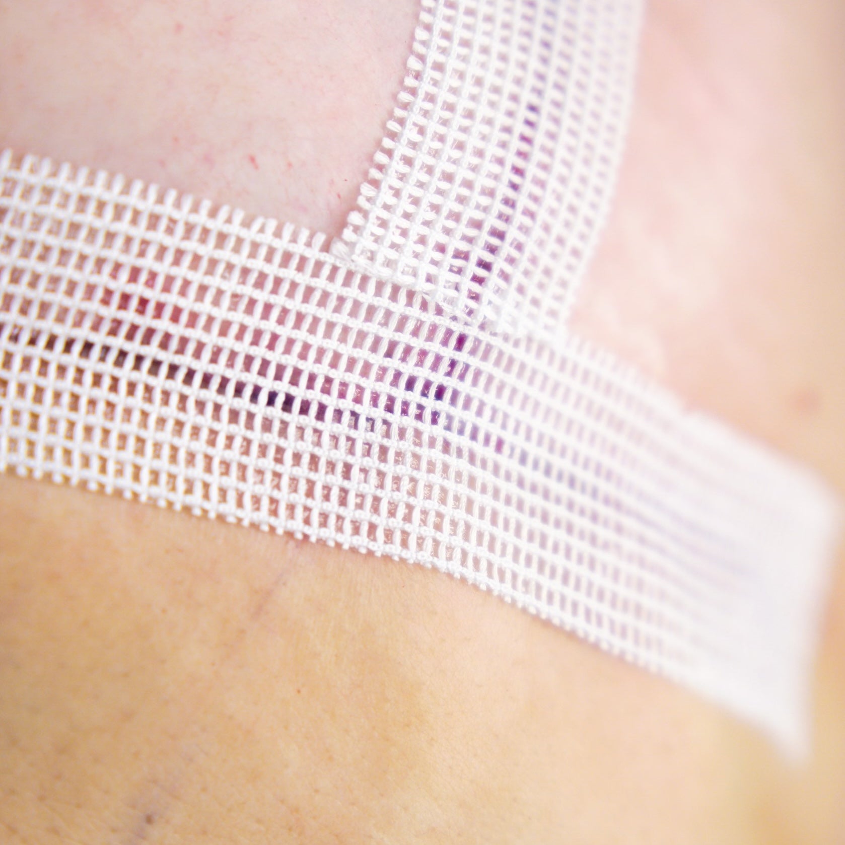 SYLKE® Adhesive Wound Closure | SYLKE®