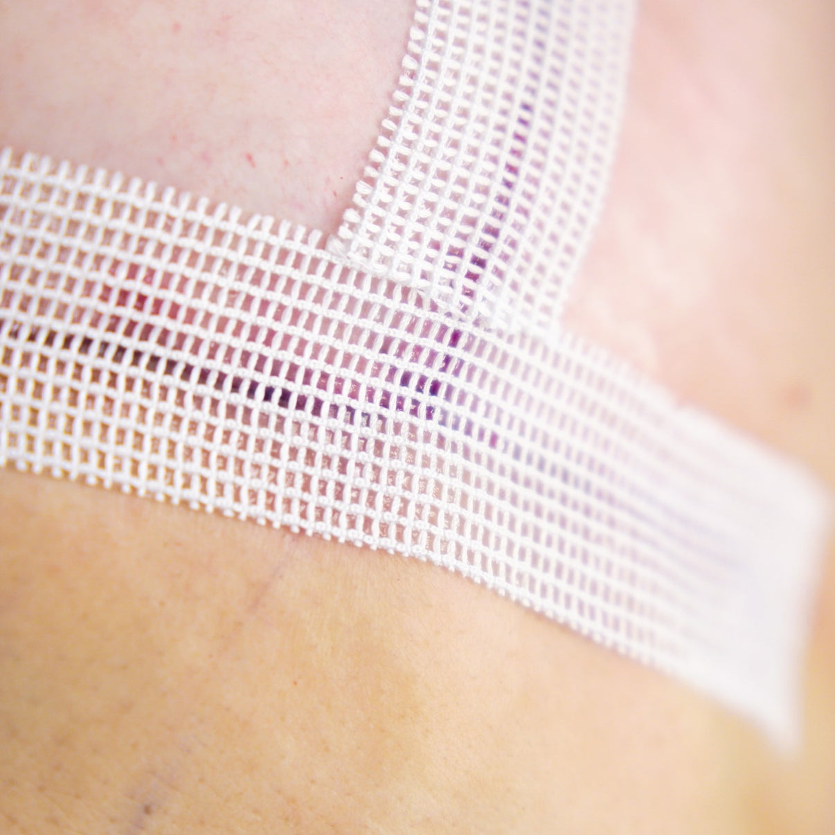 SYLKE® Adhesive Wound Closure