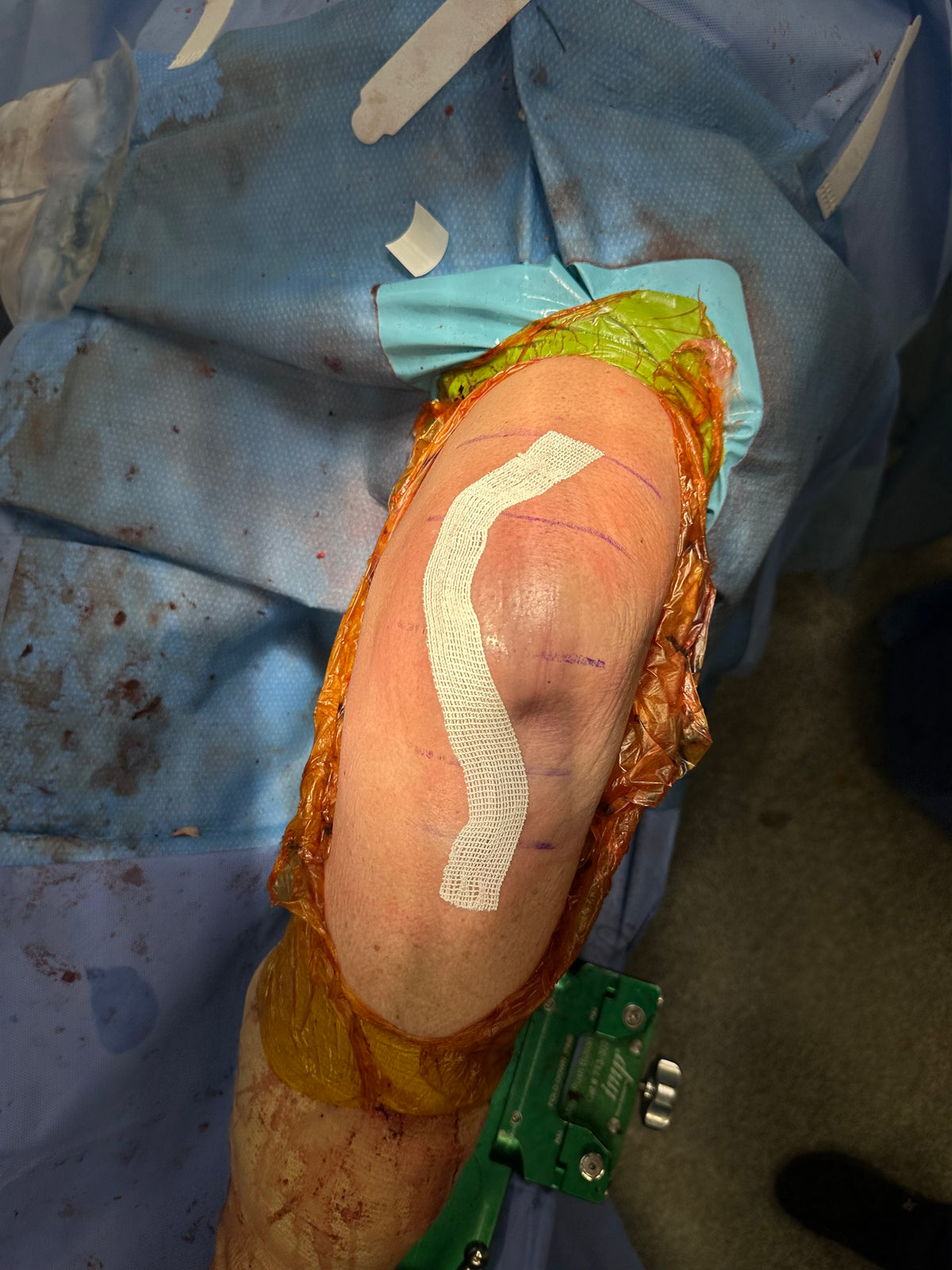 SYLKE® Skin Closure being applied in the operating room